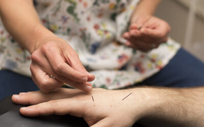 The Differences Between Acupuncture and Dry Needling